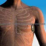 小型醫療電子設備植入式心律轉復除顫器：能持續地監...